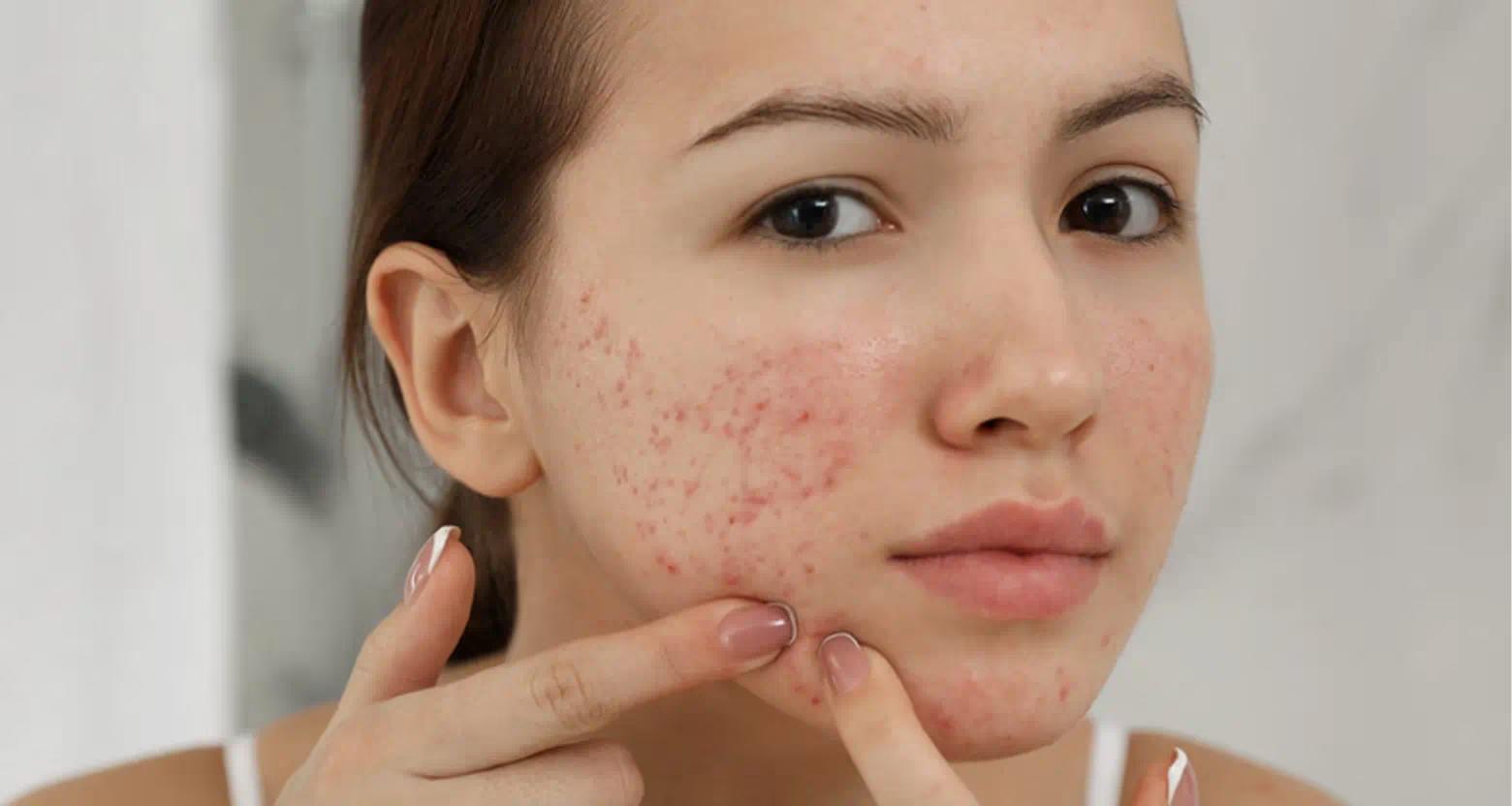 Cách trị mụn hiệu quả